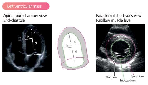 lv volume echo|normal lv diameter.